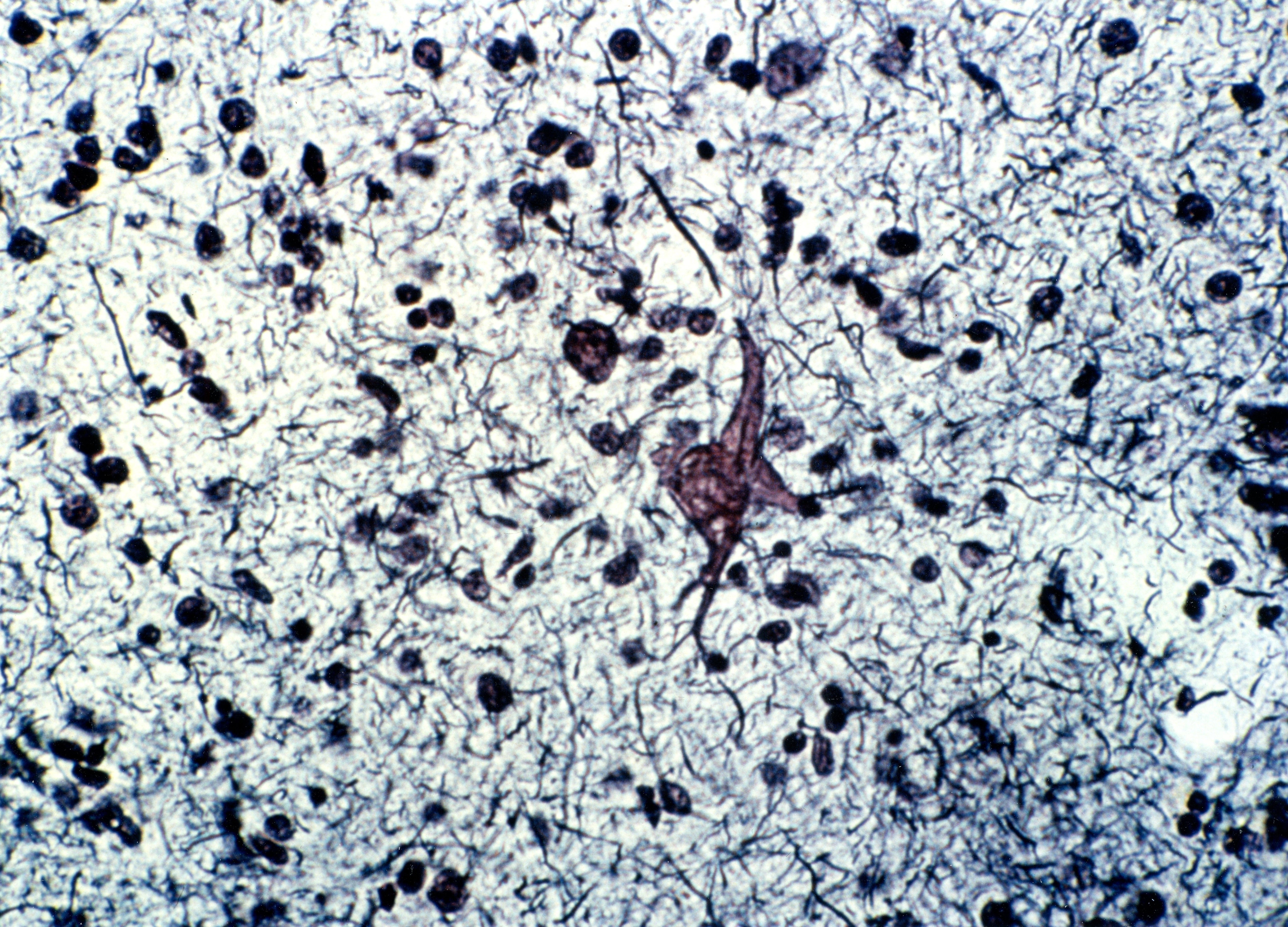 Neurofibrillen-Bündel unter dem Mikroskop