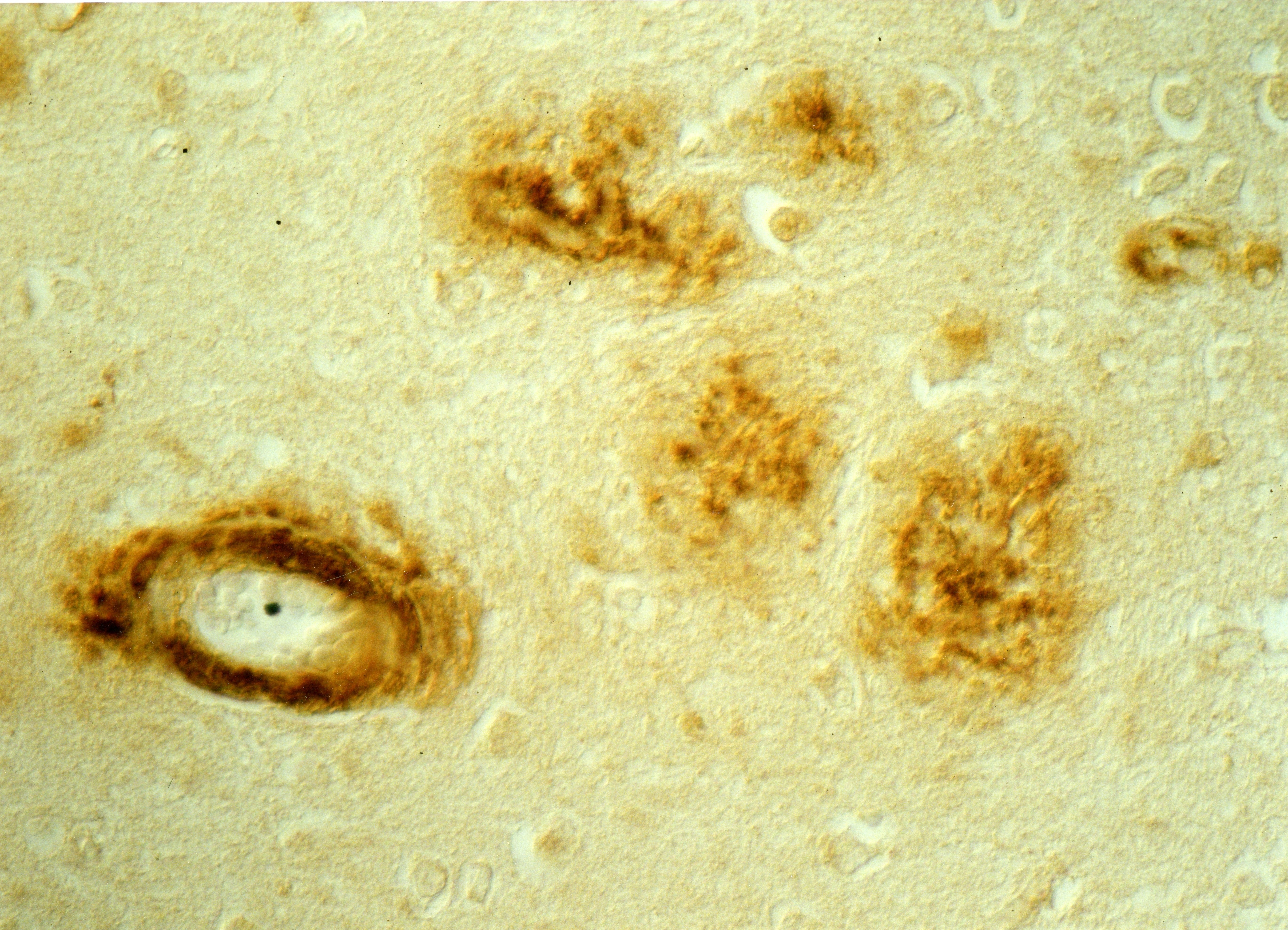 Gehirn-Plaques unter dem Mikroskop